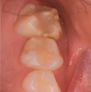 Mih Una Nuova Sindrome In Odontoiatria Studio Pediatrico Dott